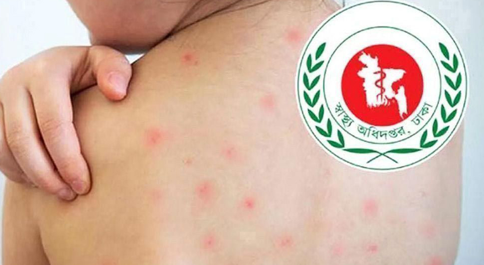হামের উপসর্গে ২৪ ঘণ্টায় আরও ৩ মৃত্যু, হাসপাতালে নতুন ১ হাজার ২১৬